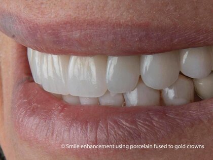 PFM's with high translucency characteristics porcelain on metal crowns