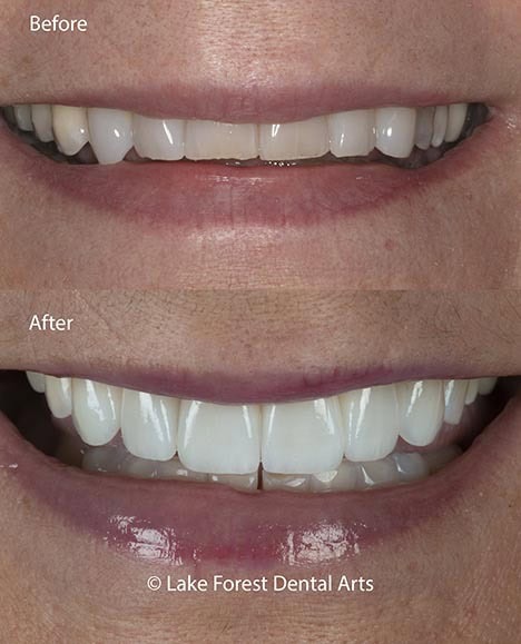 Prepless veneers placed on worn down teeth prepless veneers before and after
