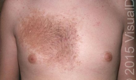 Irregular Skin Patch on a 16-Year-Old Boy Irregular Skin Patch on a 16-Year-Old Boy
