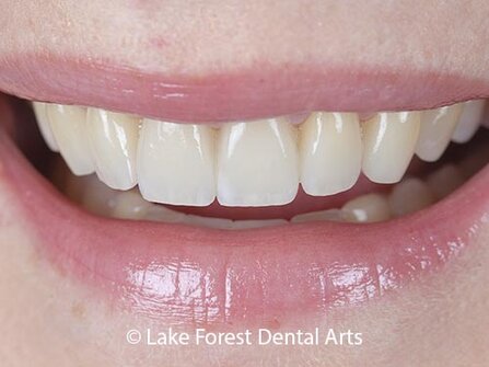 veneers can make teeth strong