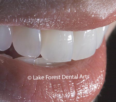 Smile correction with porcelain veneers