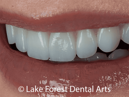 natural looking porcelain veneers Cosmetic tooth coverings
