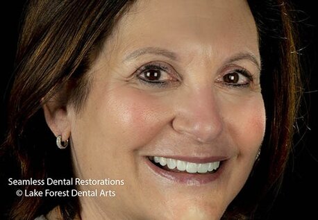 Smile makeover by Dr Fondriest Smile makeover with porcelain veneers
