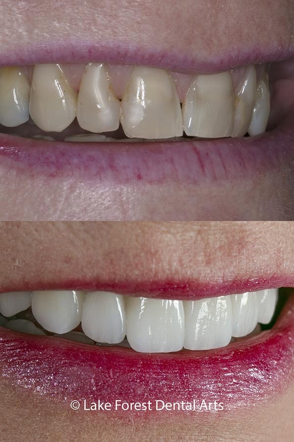 A smile makeover done with veneers Veneers before and after