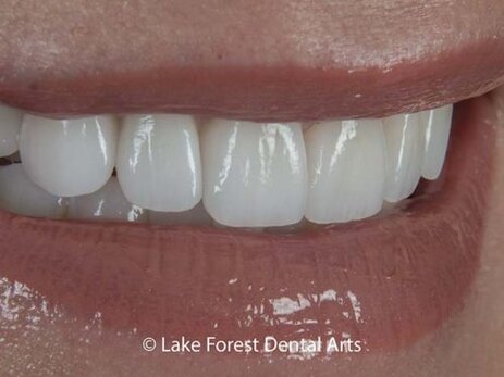 Custom Fitted Crowns Custom Fitted Crowns