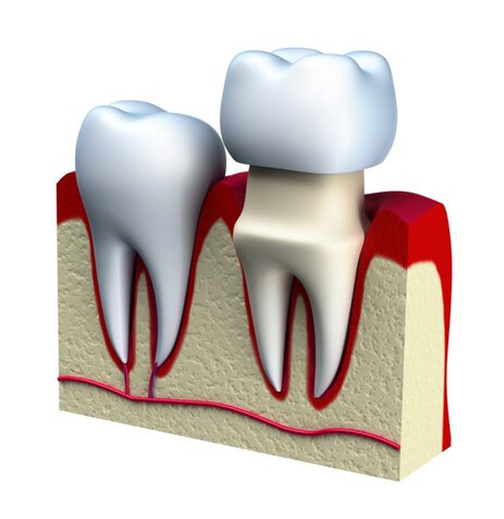 How the best crowns are designed how to choose the best crowns
