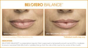 Belotero Before & After Photos: Set 5