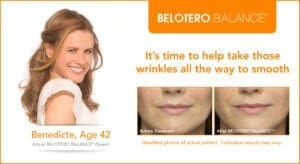 Belotero Balance Photos- Before & After