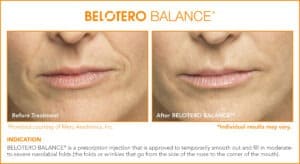 Belotero Before & After Photos: Set 4