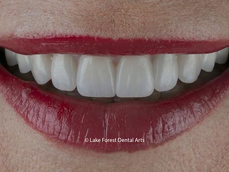 Ultra thin veneers are durable