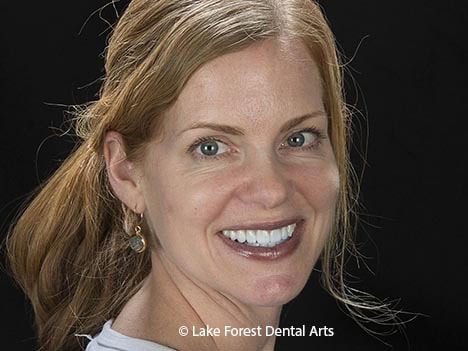 Increasing the lengths of front teeth, gives the impression of a face lift Cosmetic Dental Face lifts
