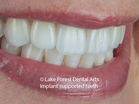 dental implant crown tooth replacement with a dental implant