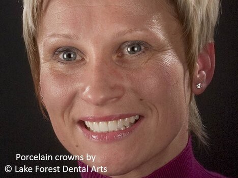 Beautiful after image of patient with porcelain crowns advantages of porcelain crowns