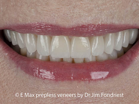 Cover stained teeth with Emax veneers Cover stained teeth with Emax