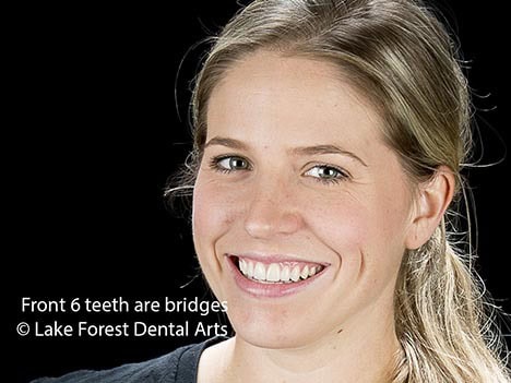 replace your teeth