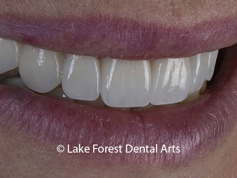Dental implants are a safe way to support dental crowns in a smile makeover. Dental implants are safe for smile makeovers