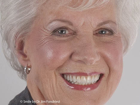 Beautiful smile makeover High end cosmetic dentistry