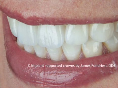 Front two teeth are dental implant crowns done by implant dentist Dental Implants | implant crown | implant dentist