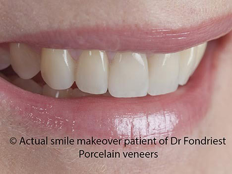 Veneers are good for teeth
