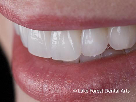 Cosmetic Dentistry Example Images Cosmetic dentistry before and after image of smile makeover