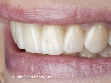 Get straight teeth instantly with veneers Veneers instead of braces