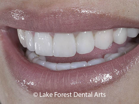porcelain crowns