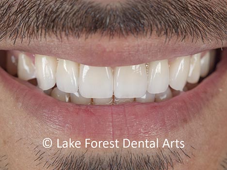 Smile makeover done with implant crowns and regular crowns implant crowns