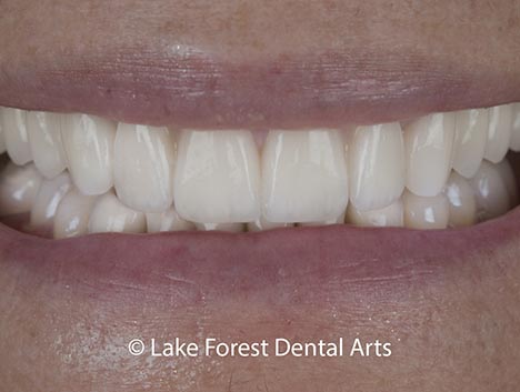 dental crowns