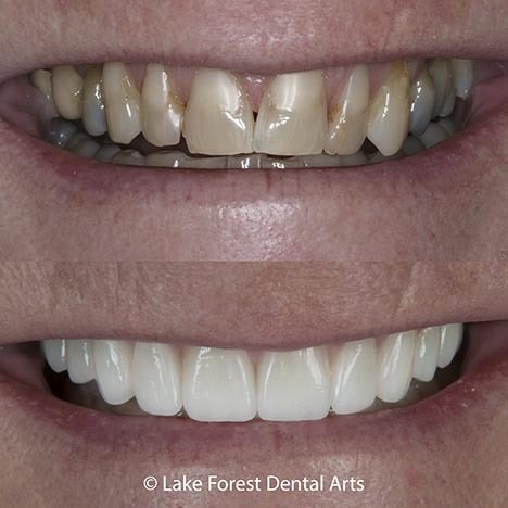 veneers before and after treatment Veneer teeth before and after