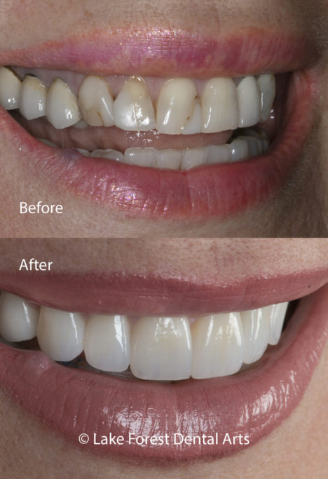 before and after treatment photos of zirconium crowns Zirconium crowns