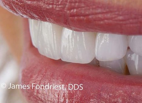 Single Tooth Implants