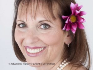 Smile makeover to fix the black lines at the gumline Dental makeover