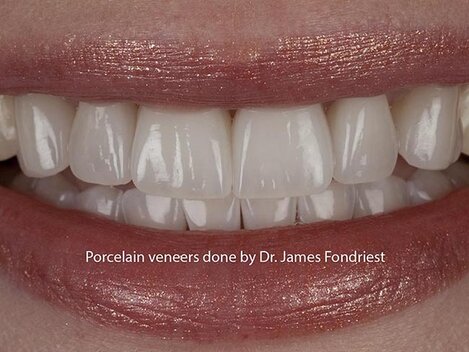 porcelain veneers for chipped teeth