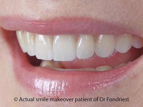 Smile makeover done with veneers Veneers are worth the cost
