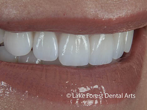 Cosmetic Mouth Reconstruction prosthodontic makeover