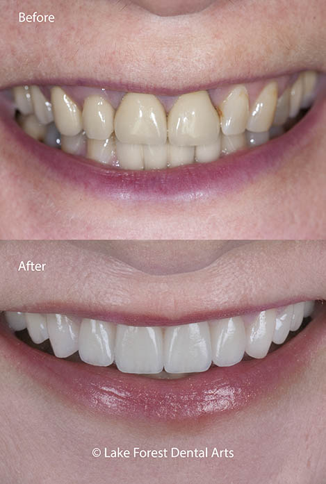 Change your tooth shapes