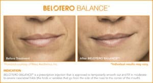 Belotero Before & After Photos: Set 1