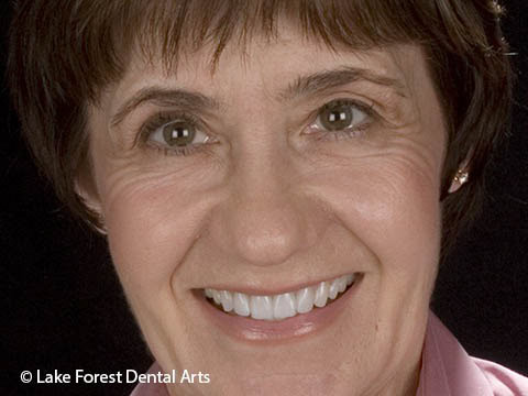 dental crowns before and after Straighten teeth without braces