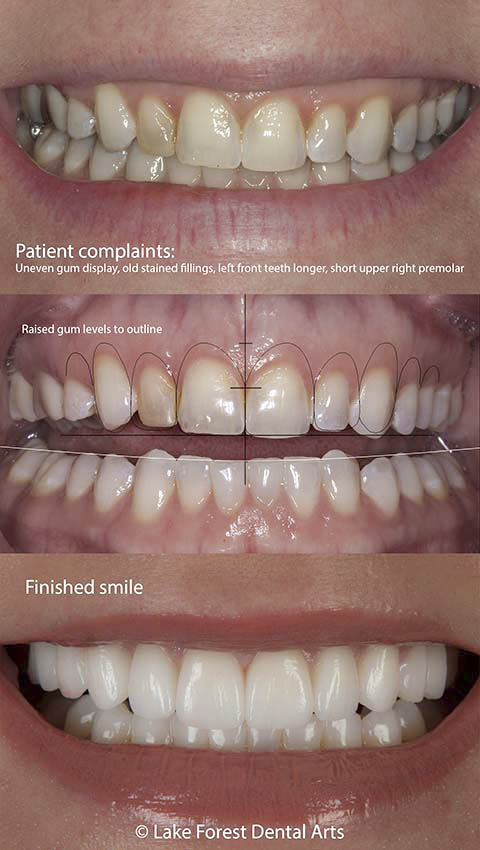 gum reshaping