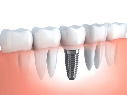 Implant dentaire dentiste amouyal Paris 16