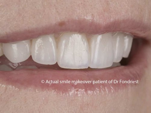 Get a smile makeover consultation done before porcelain veneers Dental consultation