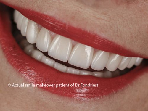 Common Dental Implant Mistakes