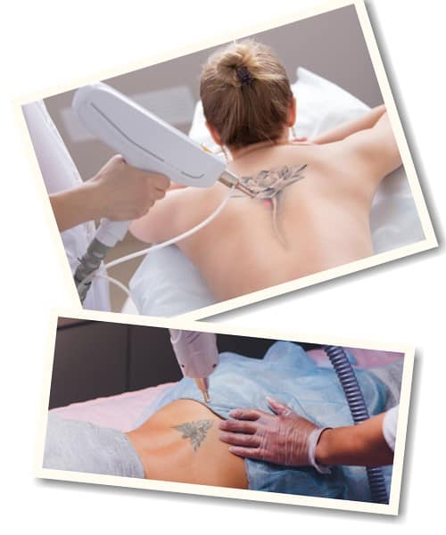 picosure удаление тату