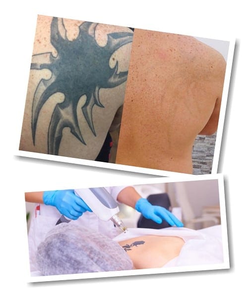 Сведение Тату Лазером Фото До и После | Эффект от Метода
