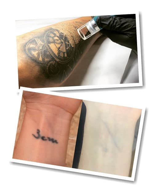 Сведение Тату Лазером Фото До и После | Эффект от Метода