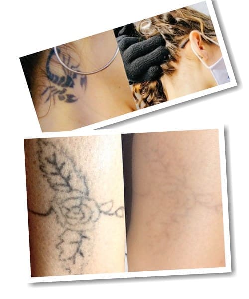 Сведение Тату Лазером Фото До и После | Эффект от Метода