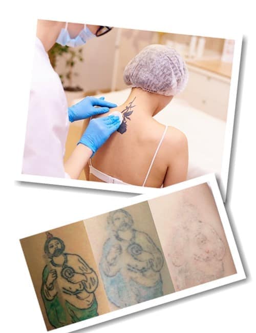 Як видаляють татуювання лазером