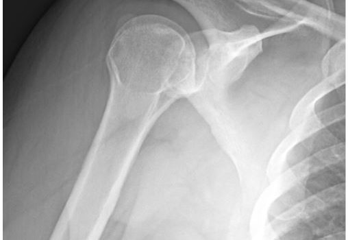 A 42-Year-Old Male with Worsening Chronic Shoulder Pain A 42-Year-Old Male with Worsening Chronic Shoulder Pain