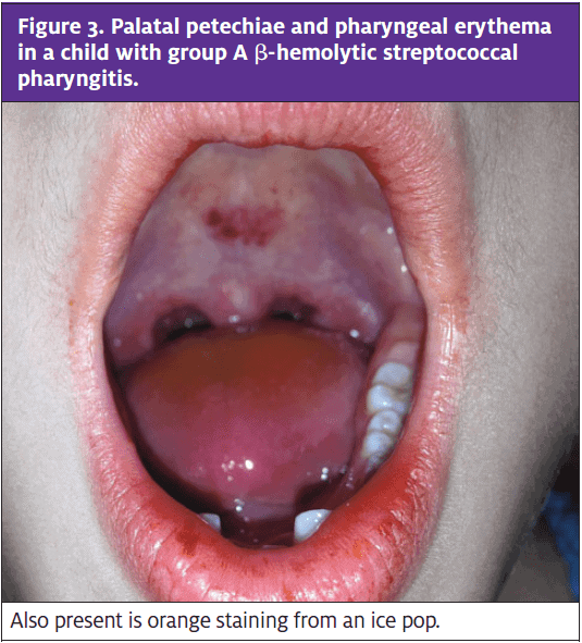 Pediatric Oral Lesions in the Urgent Care Setting - Journal of Urgent ...
