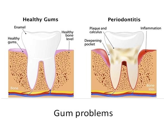 Gum problems